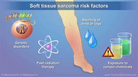 soft tissue sarcoma leg prognosis